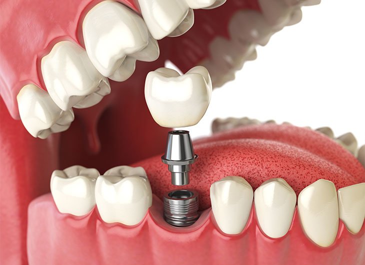 dental-implant